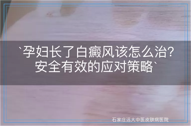 `孕妇长了白癜风该怎么治？安全有效的应对策略`