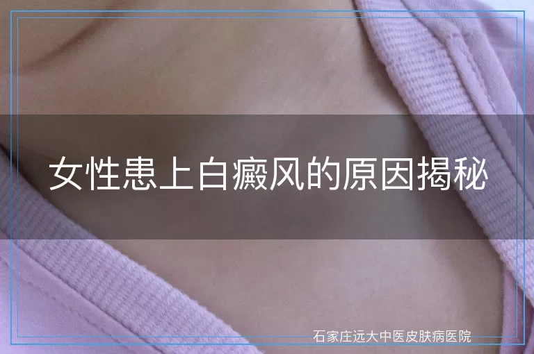 女性患上白癜风的原因揭秘