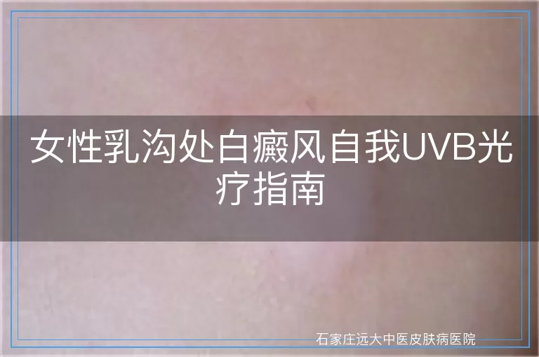 女性乳沟处白癜风自我UVB光疗指南