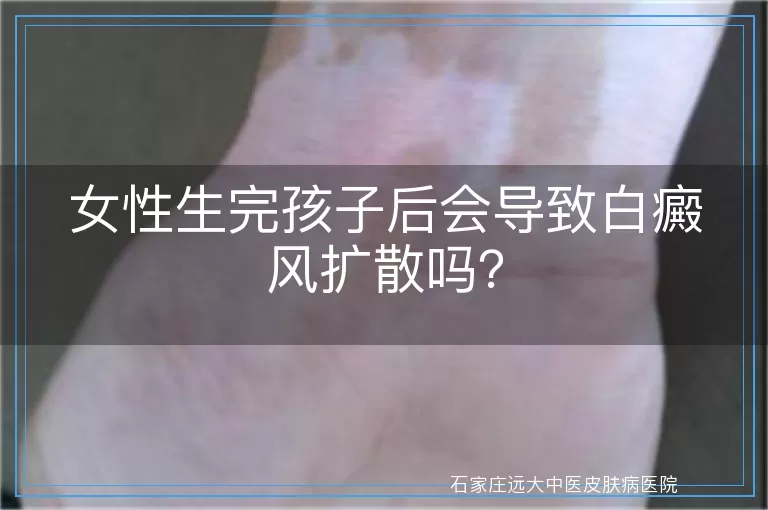 女性生完孩子后会导致白癜风扩散吗？