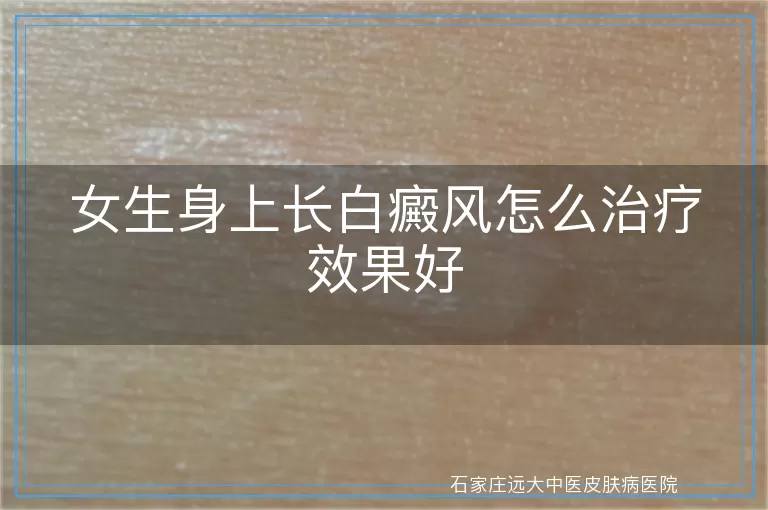 女生身上长白癜风怎么治疗效果好