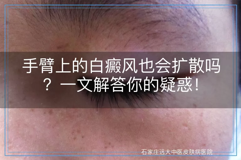 手臂上的白癜风也会扩散吗？一文解答你的疑惑！