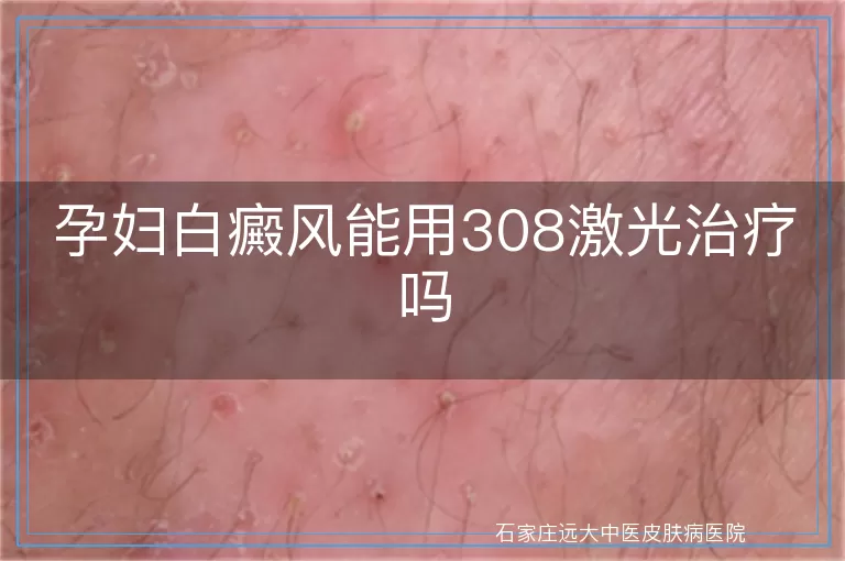 孕妇白癜风能用308激光治疗吗