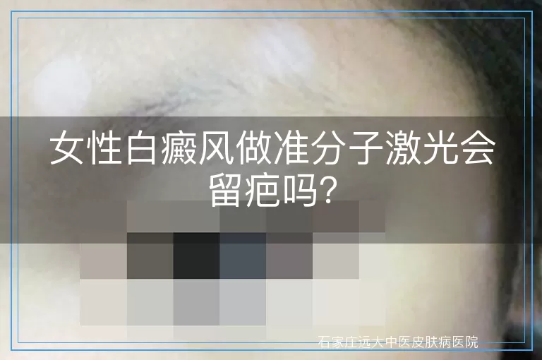 女性白癜风做准分子激光会留疤吗？