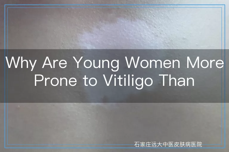 Why Are Young Women More Prone to Vitiligo Than Men?