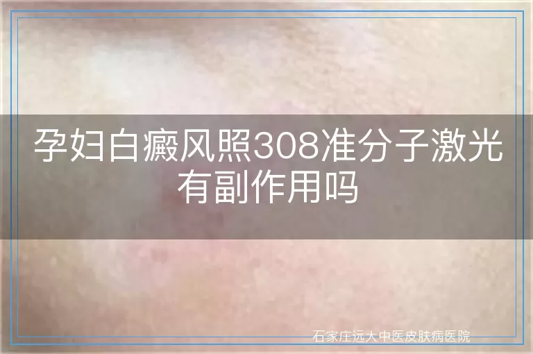 孕妇白癜风照308准分子激光有副作用吗