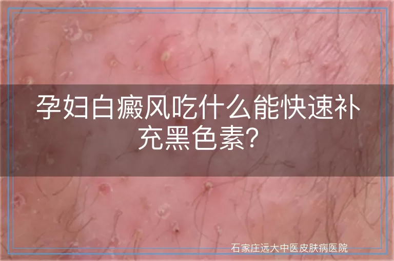 孕妇白癜风吃什么能快速补充黑色素？