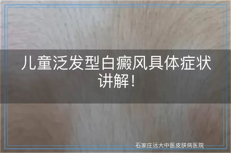 儿童泛发型白癜风具体症状讲解！