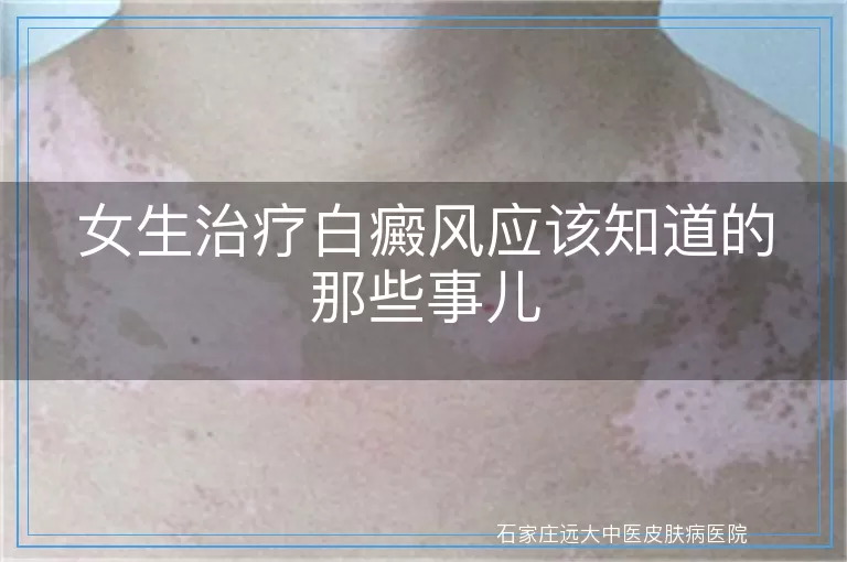 女生治疗白癜风应该知道的那些事儿