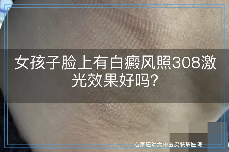 女孩子脸上有白癜风照308激光效果好吗？