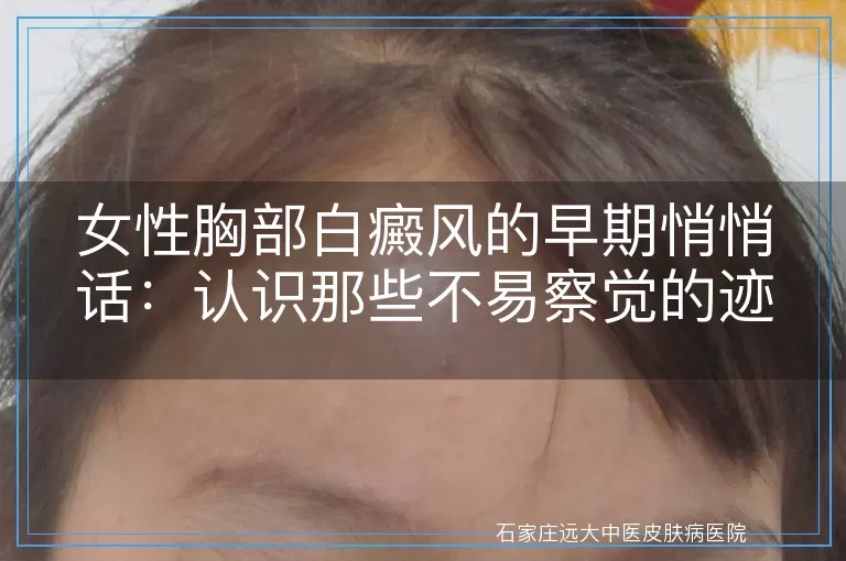 女性胸部白癜风的早期悄悄话：认识那些不易察觉的迹象