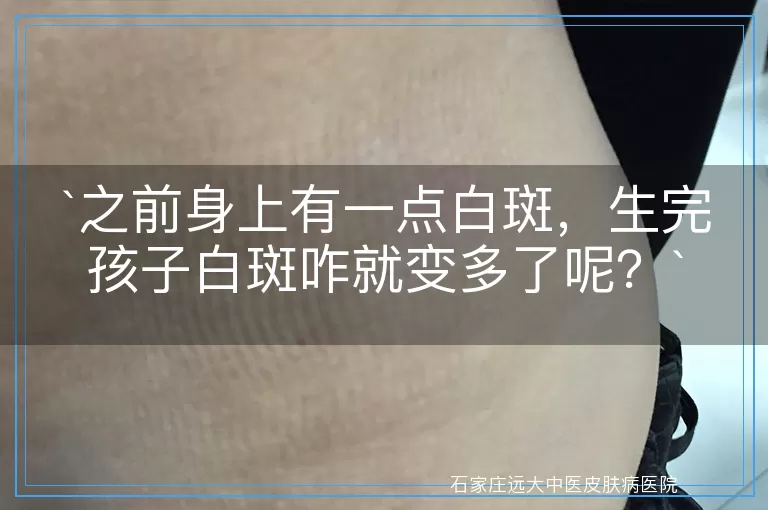 之前身上有一点白斑，生完孩子白斑咋就变多了呢？