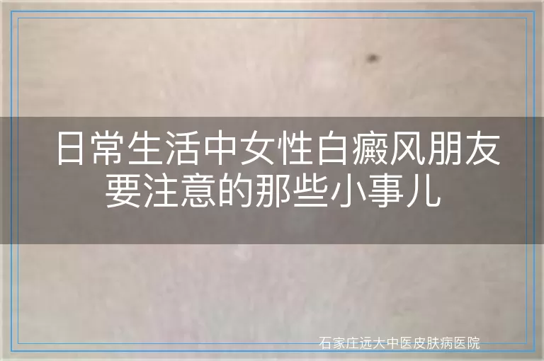 日常生活中女性白癜风朋友要注意的那些小事儿