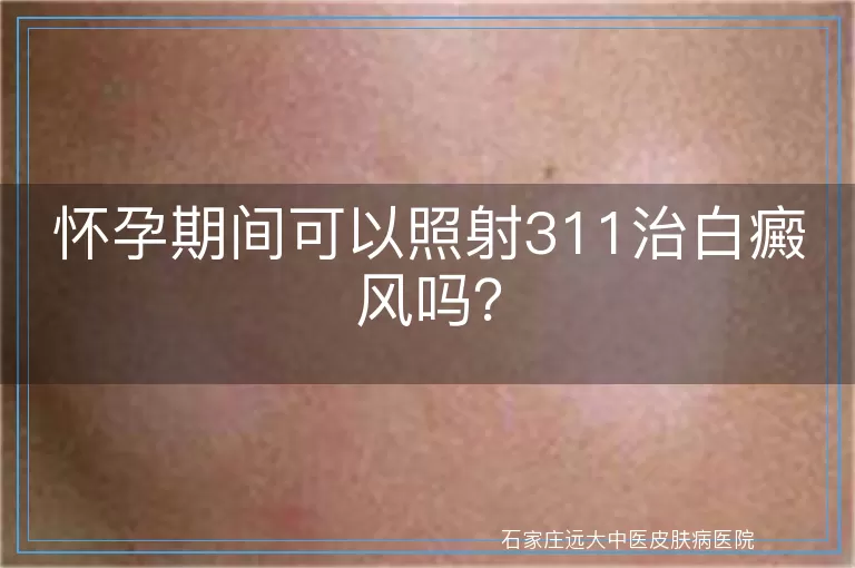 怀孕期间可以照射311治白癜风吗？