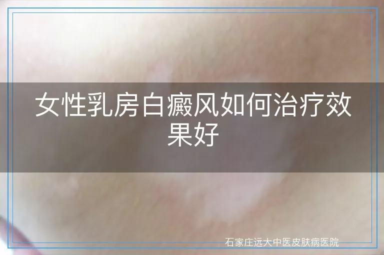 女性乳房白癜风如何治疗效果好