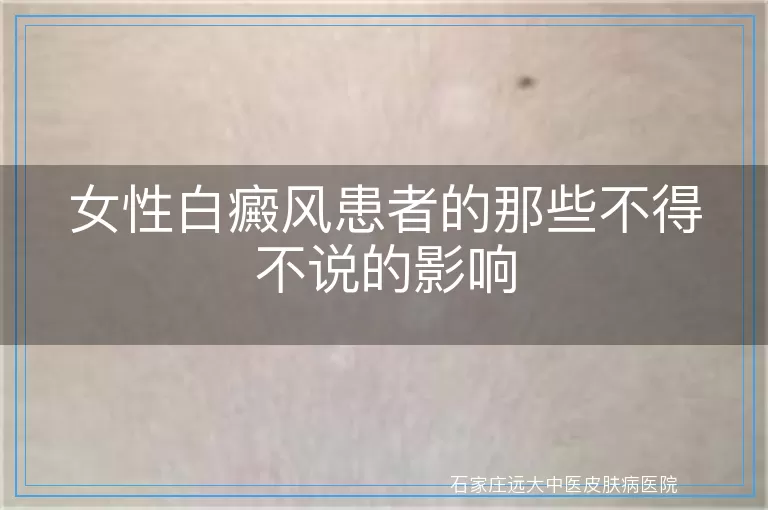 女性白癜风患者的那些不得不说的影响