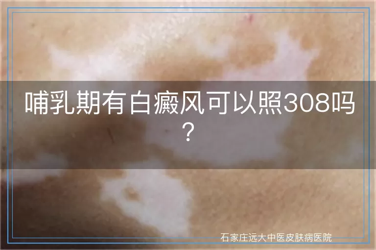 哺乳期有白癜风可以照308吗？