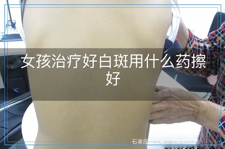 女孩治疗好白斑用什么药擦好