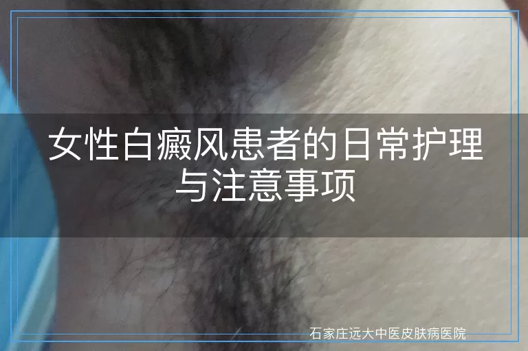 女性白癜风患者的日常护理与注意事项