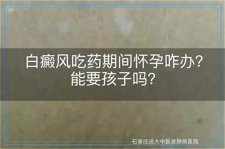 白癜风吃药期间怀孕咋办？能要孩子吗？