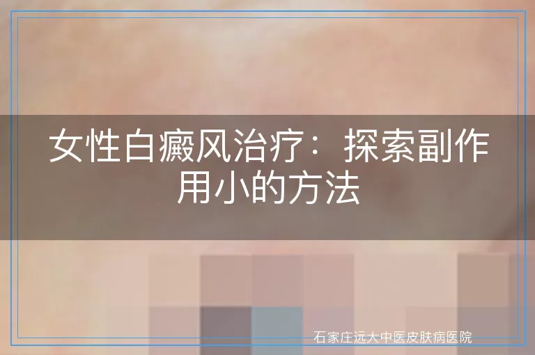 女性白癜风治疗：探索副作用小的方法