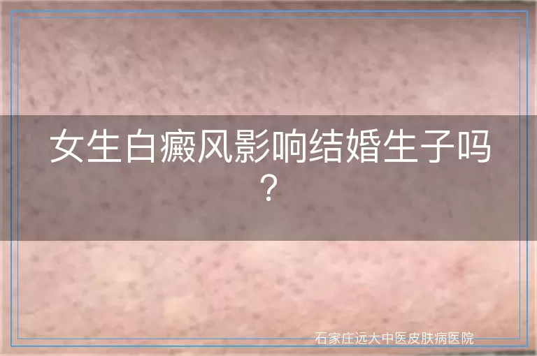 女生白癜风影响结婚生子吗？