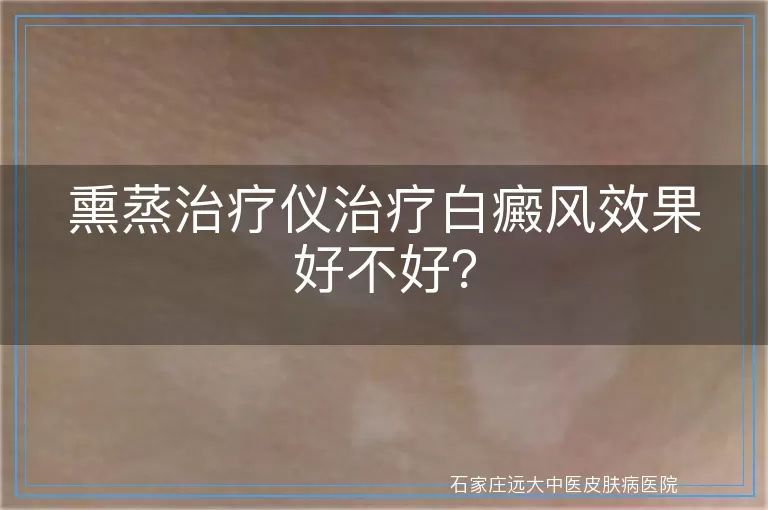 熏蒸治疗仪治疗白癜风效果好不好？