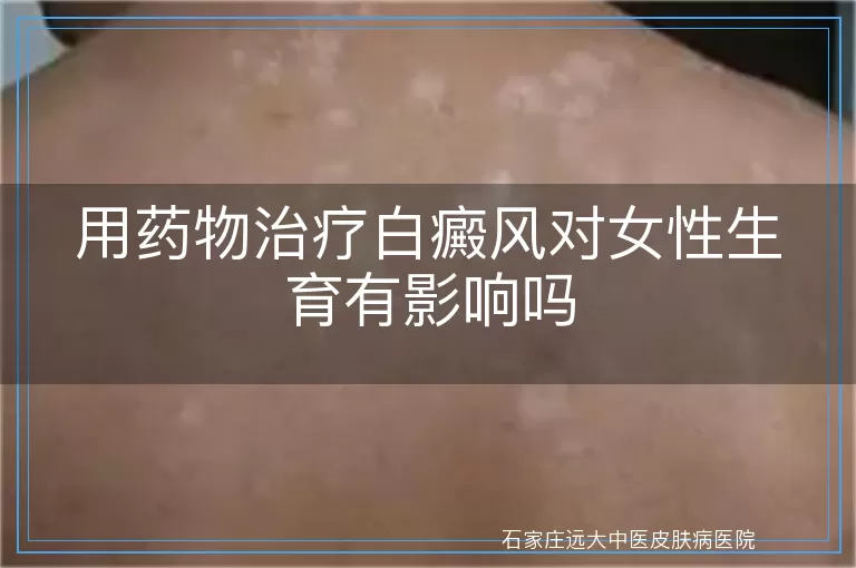 用药物治疗白癜风对女性生育有影响吗