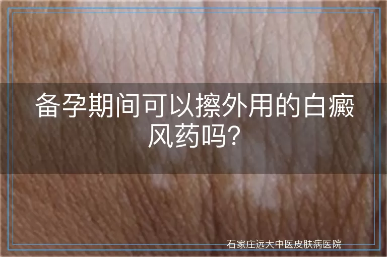 备孕期间可以擦外用的白癜风药吗？