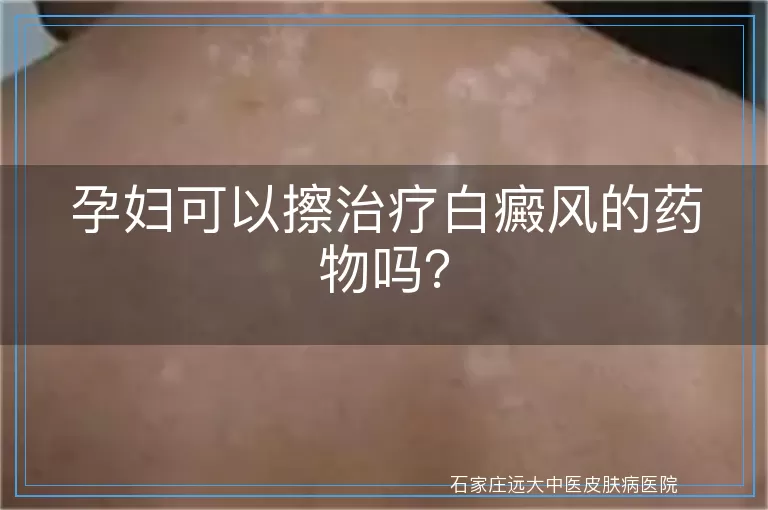 孕妇可以擦治疗白癜风的药物吗？