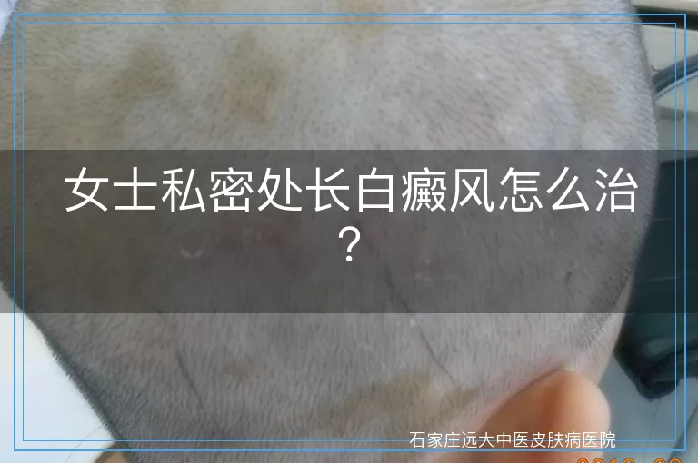 女士私密处长白癜风怎么治？