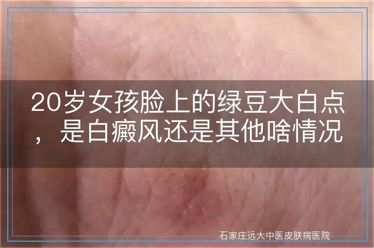 20岁女孩脸上的绿豆大白点，是白癜风还是其他啥情况？