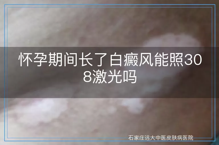 怀孕期间长了白癜风能照308激光吗