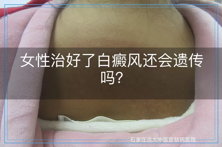 女性治好了白癜风还会遗传吗？