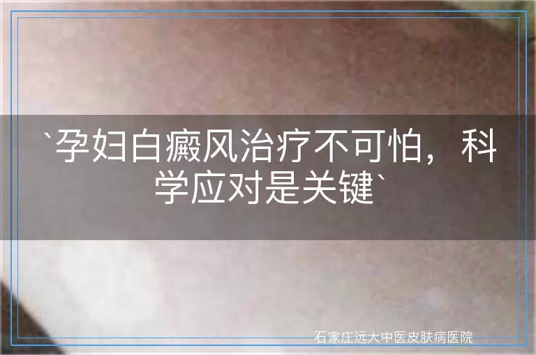 孕妇白癜风治疗不可怕，科学应对是关键