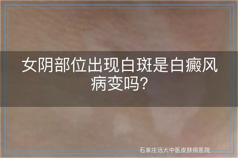 女阴部位出现白斑是白癜风病变吗？