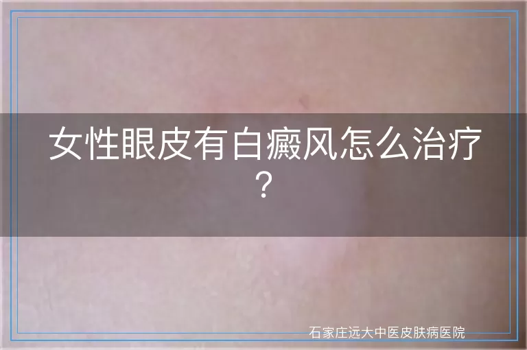 女性眼皮有白癜风怎么治疗？