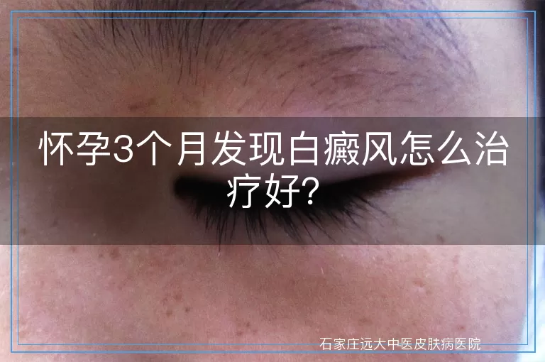 怀孕3个月发现白癜风怎么治疗好？