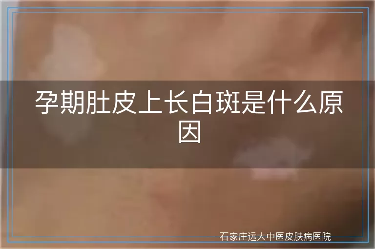 孕期肚皮上长白斑是什么原因