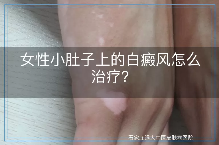 女性小肚子上的白癜风怎么治疗？