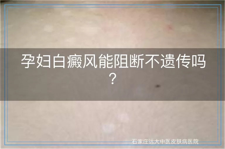 孕妇白癜风能阻断不遗传吗？