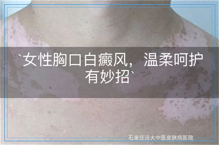 女性胸口白癜风，温柔呵护有妙招