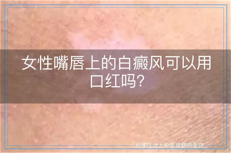 女性嘴唇上的白癜风可以用口红吗？