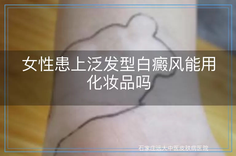 女性患上泛发型白癜风能用化妆品吗