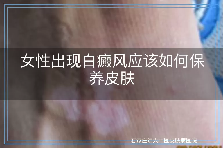 女性出现白癜风应该如何保养皮肤