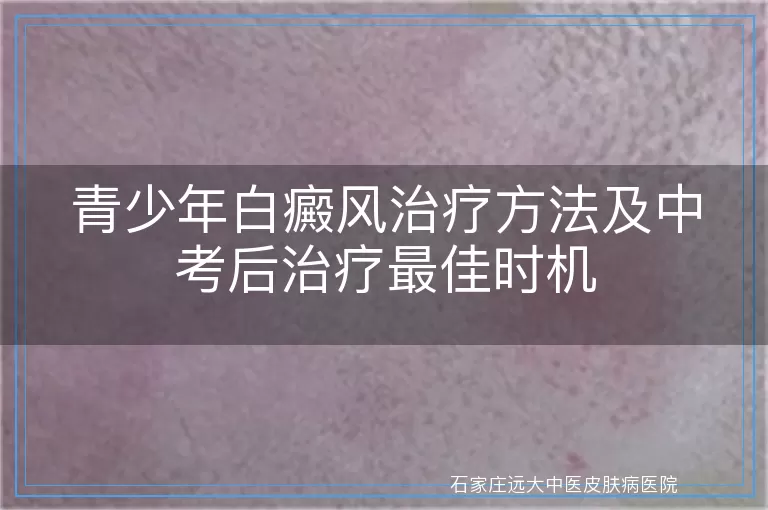 青少年白癜风治疗方法及中考后治疗最佳时机