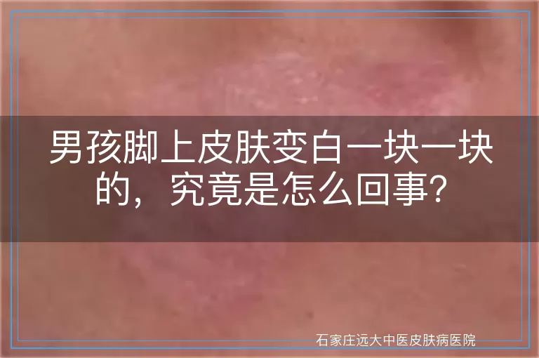 男孩脚上皮肤变白一块一块的，究竟是怎么回事？