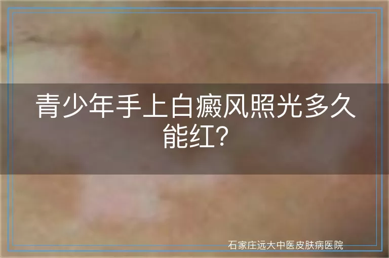 青少年手上白癜风照光多久能红？