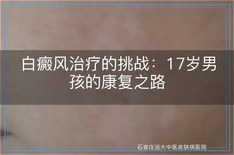 白癜风治疗的挑战：17岁男孩的康复之路