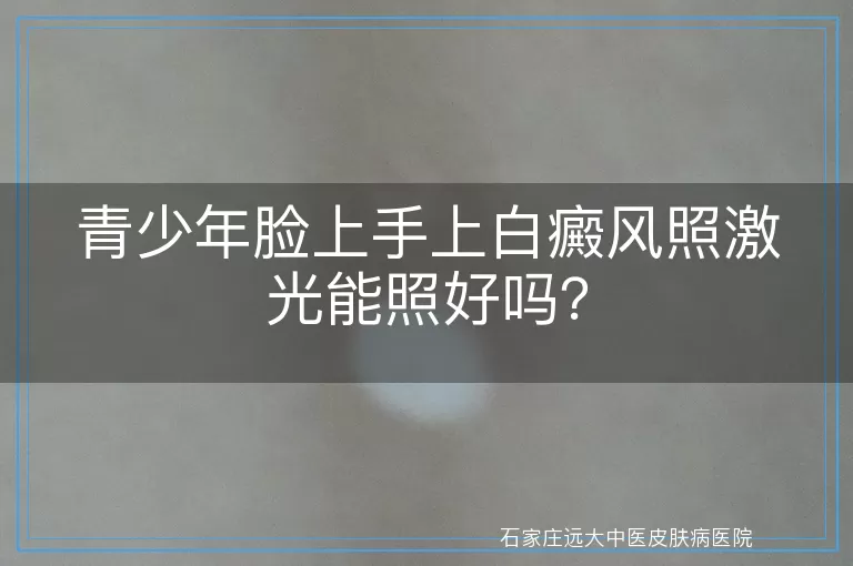 青少年脸上手上白癜风照激光能照好吗？